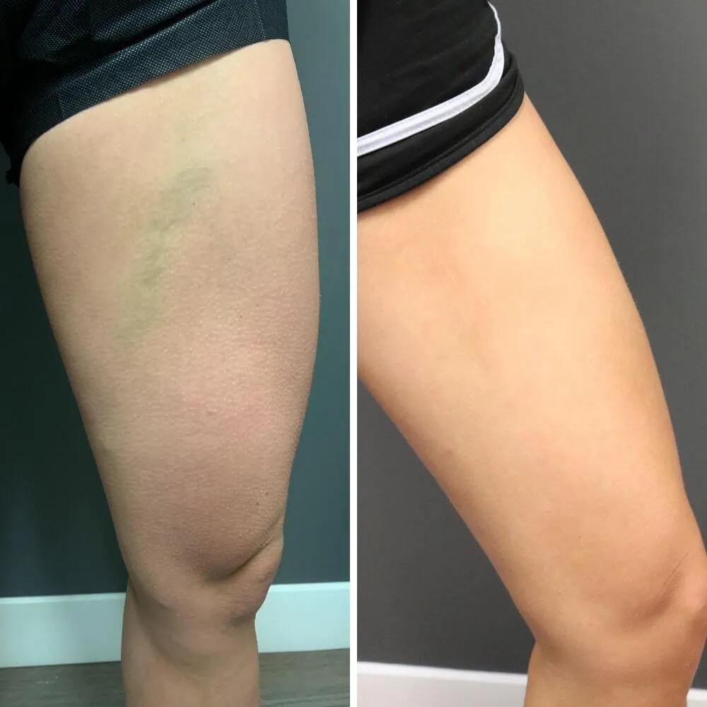 before and after photo on thigh