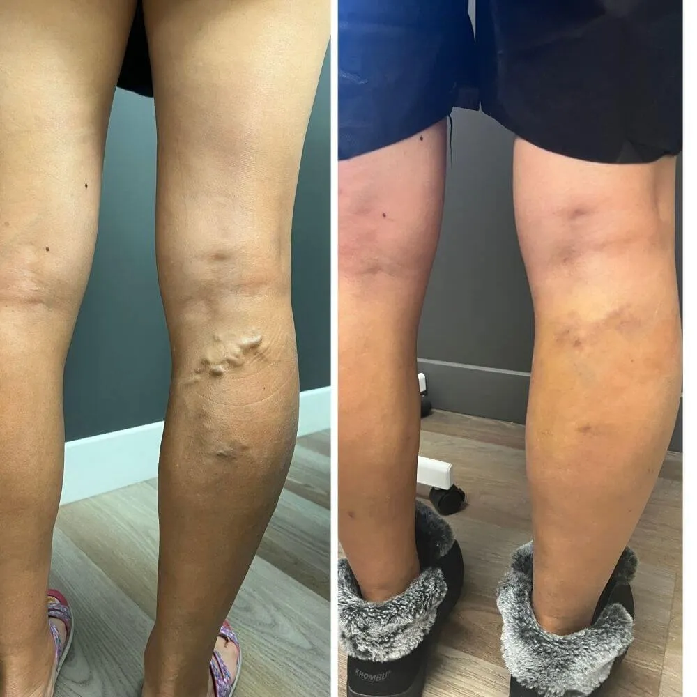 before and after photo of cvi