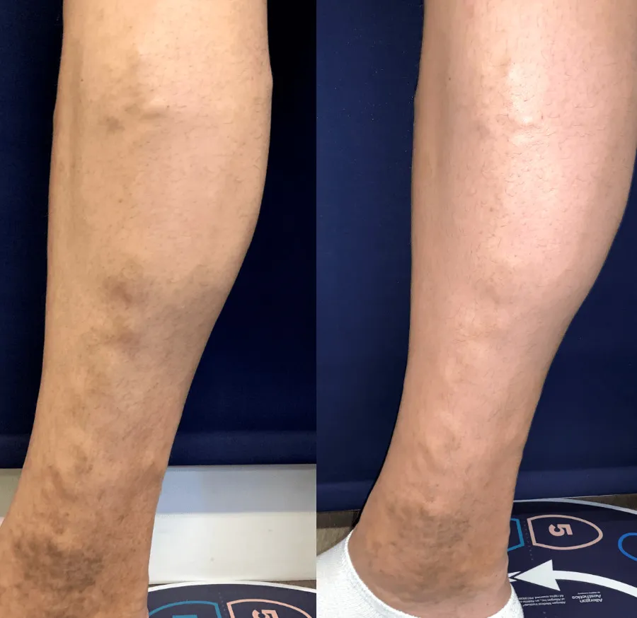 before and after photo of varicose veins