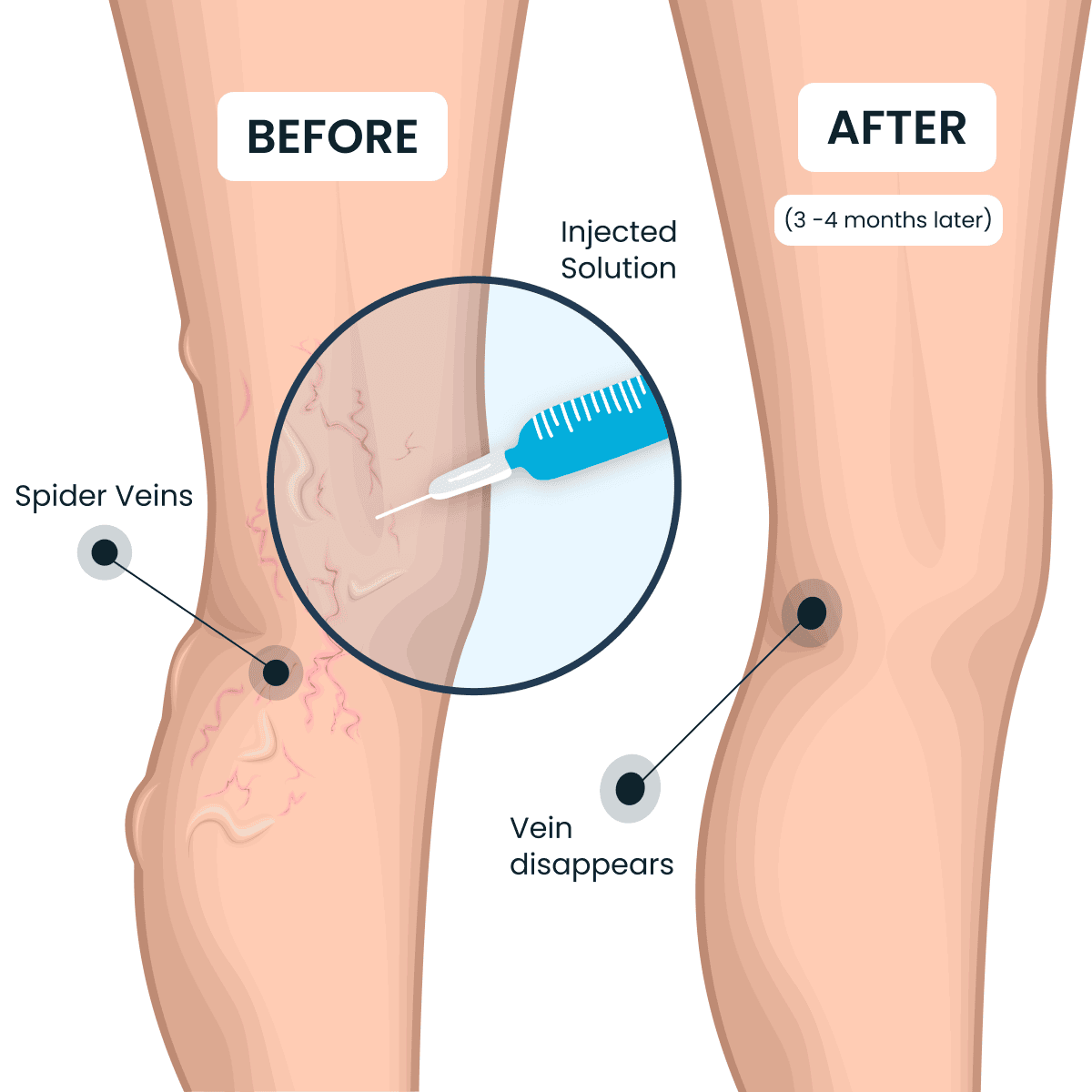 free vein screening