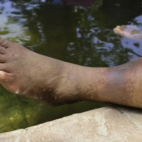 skin discoloration