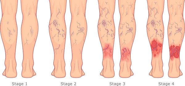 stages of vein disease