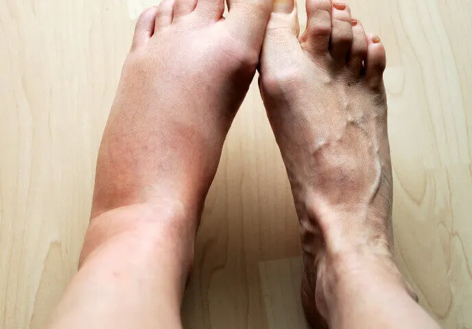 swelling legs